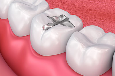 All About You Dental Group | Periodontal Treatment, Dental Bridges and Crowns  amp  Caps